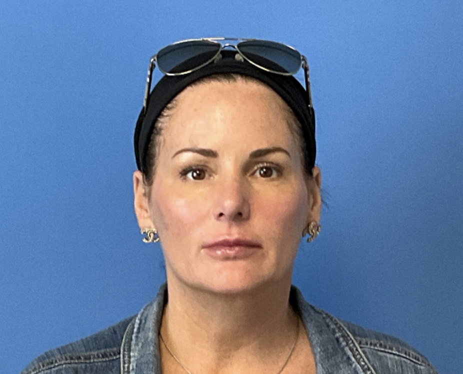 Rhinoplasty--Case-Study-2853 | Before Rhinoplasty